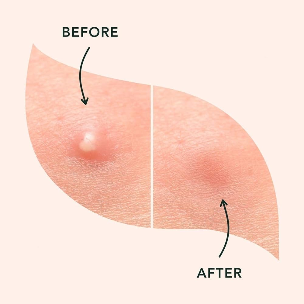 a.l.m. Magical Patch (2) Hydrocolloid pimple patches. These ultra thin & translucent hydrocolloid adhesive covers and absorb unwanted pimples. Parches Para Acne for skincare.