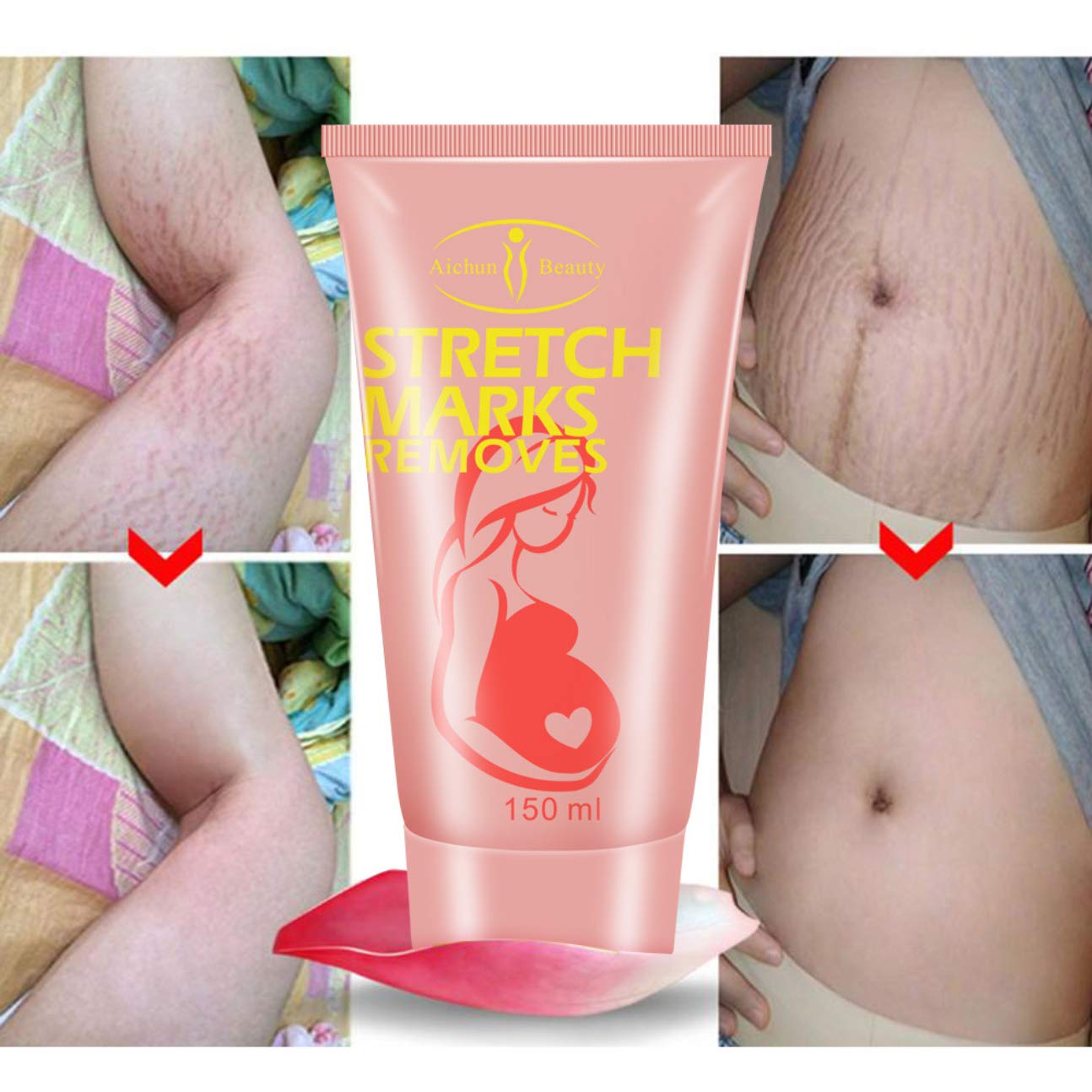 AICHUN BEAUTY Pregnancy Cream Streach Mark Remover Scars Repair Cellulites Lotion Cream 150ml