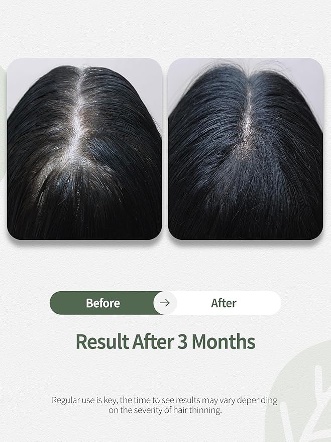 Scalp Serum for Hair Loss – Reduces Hair Shedding and Improves Scalp Health, Helps with Topical Signs of Thinning, Vegan Formula without Side-Effects, Non-Greasy