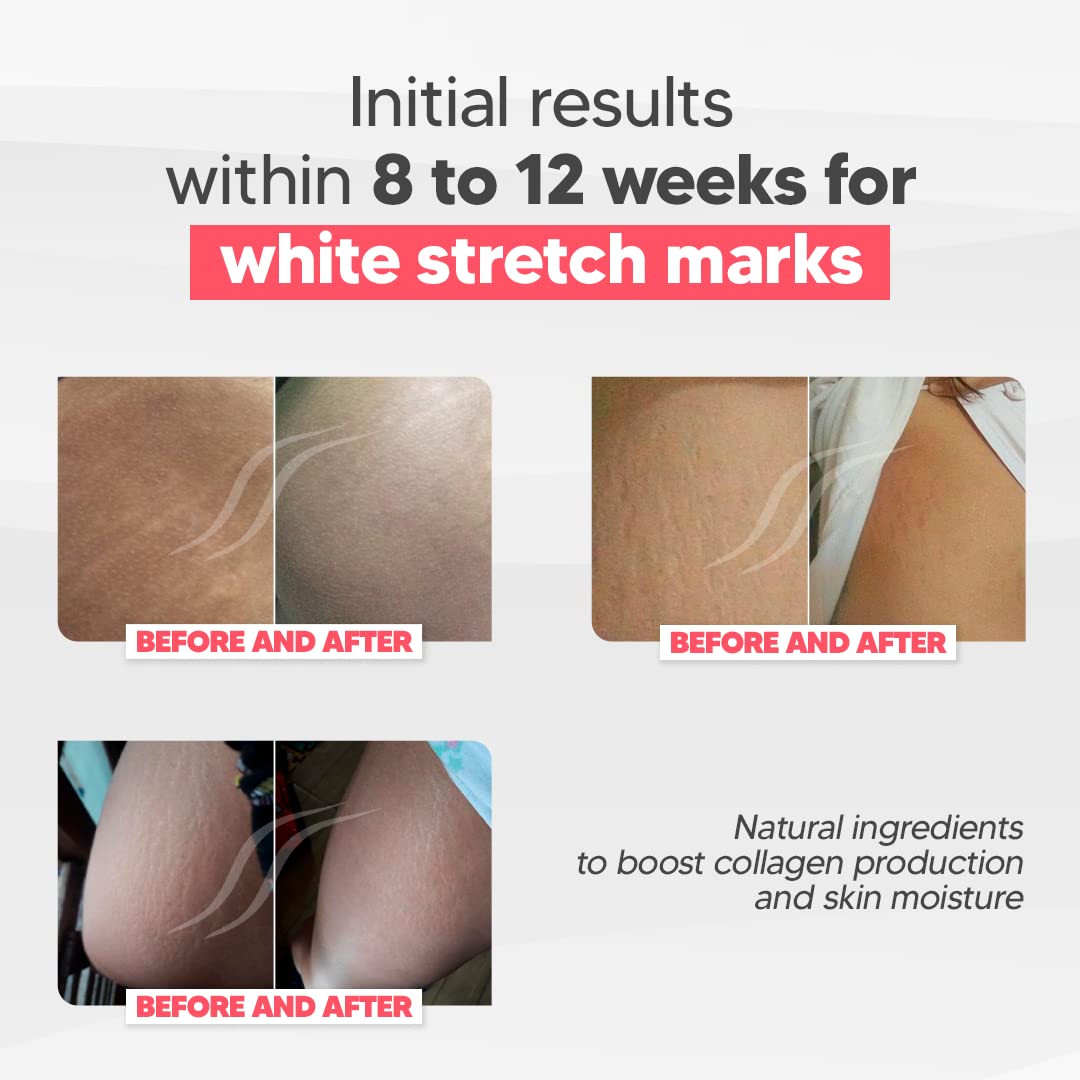 Cicatrissim White Stretch Mark Fade and Removal Cream - Innovative Formula With Pure and Powerful Natural Ingredients From Brazilian Flora - For All Skin Types.