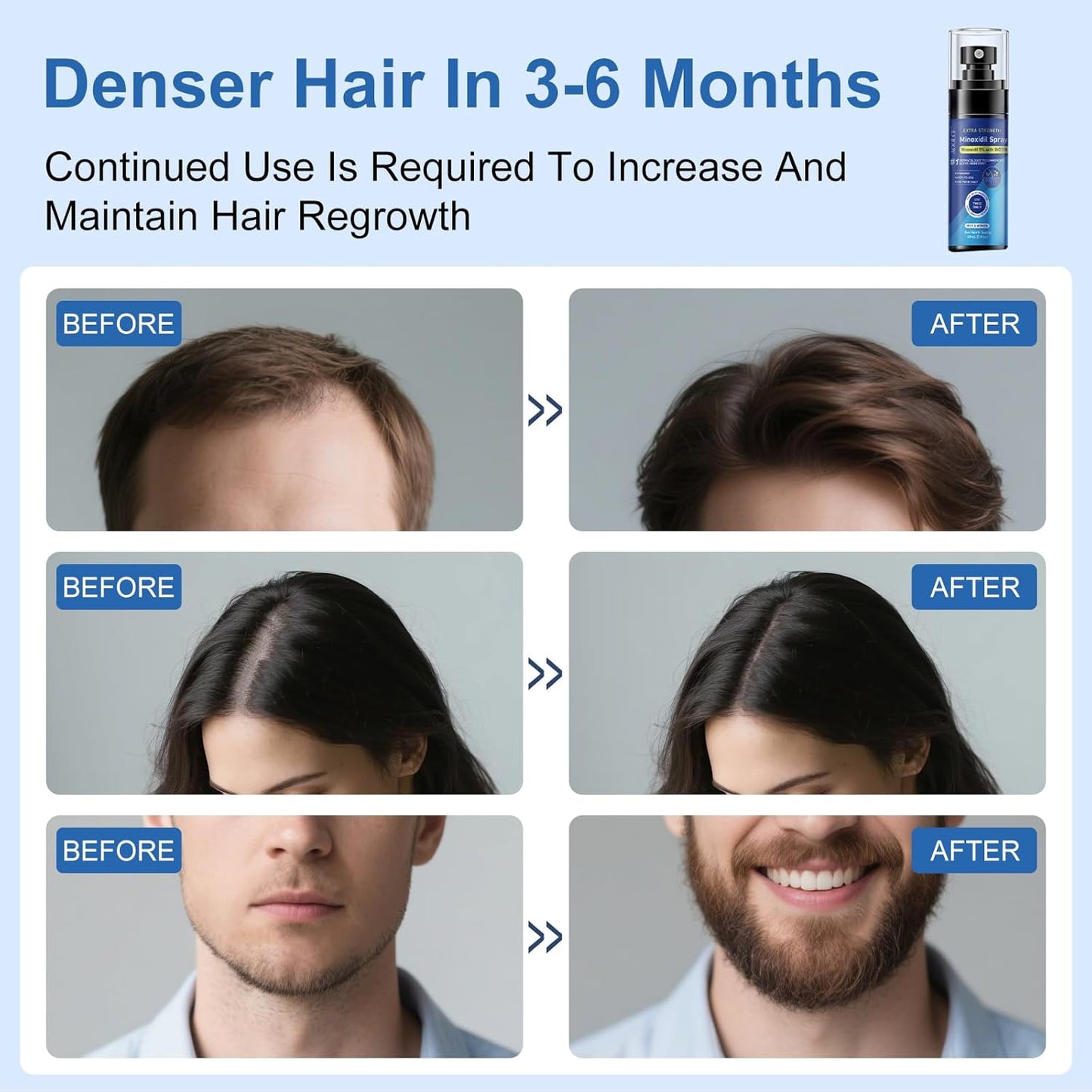 5% Minoxidil Spray for Men and Women, Infused with Biotin, for Hair Regrowth Treatment, Beard Growth, Extra Strength Treatment to Combat Hair Loss and Thinning, 6 Month Supply, 6 Bottles