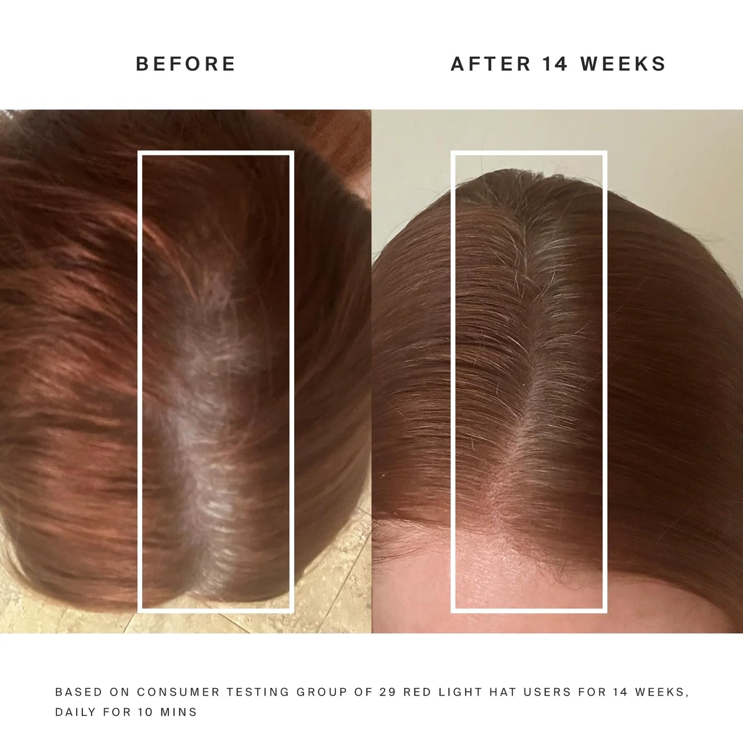 HigherDOSE Red Light Therapy Hat for Hair Growth - Reduce Hair Loss & Shedding - Targeted Infrared Red Light Therapy to Support Scalp Health