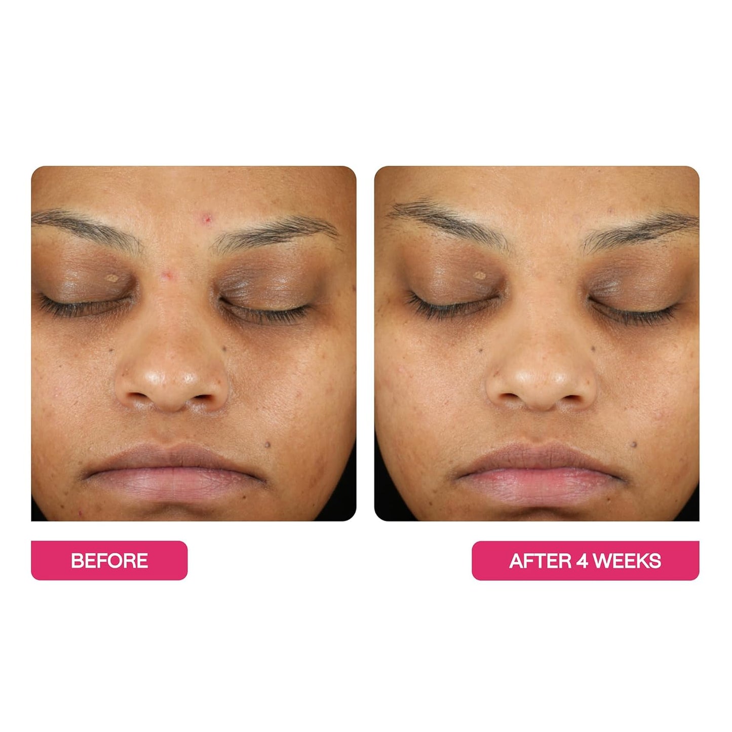 BeautyStat Triple Action One-Step Daily Exfoliating Peel Pad for Uneven Tone, Texture, Fine Lines, Enlarged Pores - Made in the USA - Gentle Exfoliator Pad with AHAs, BHAs, Glucosamine to Brighten