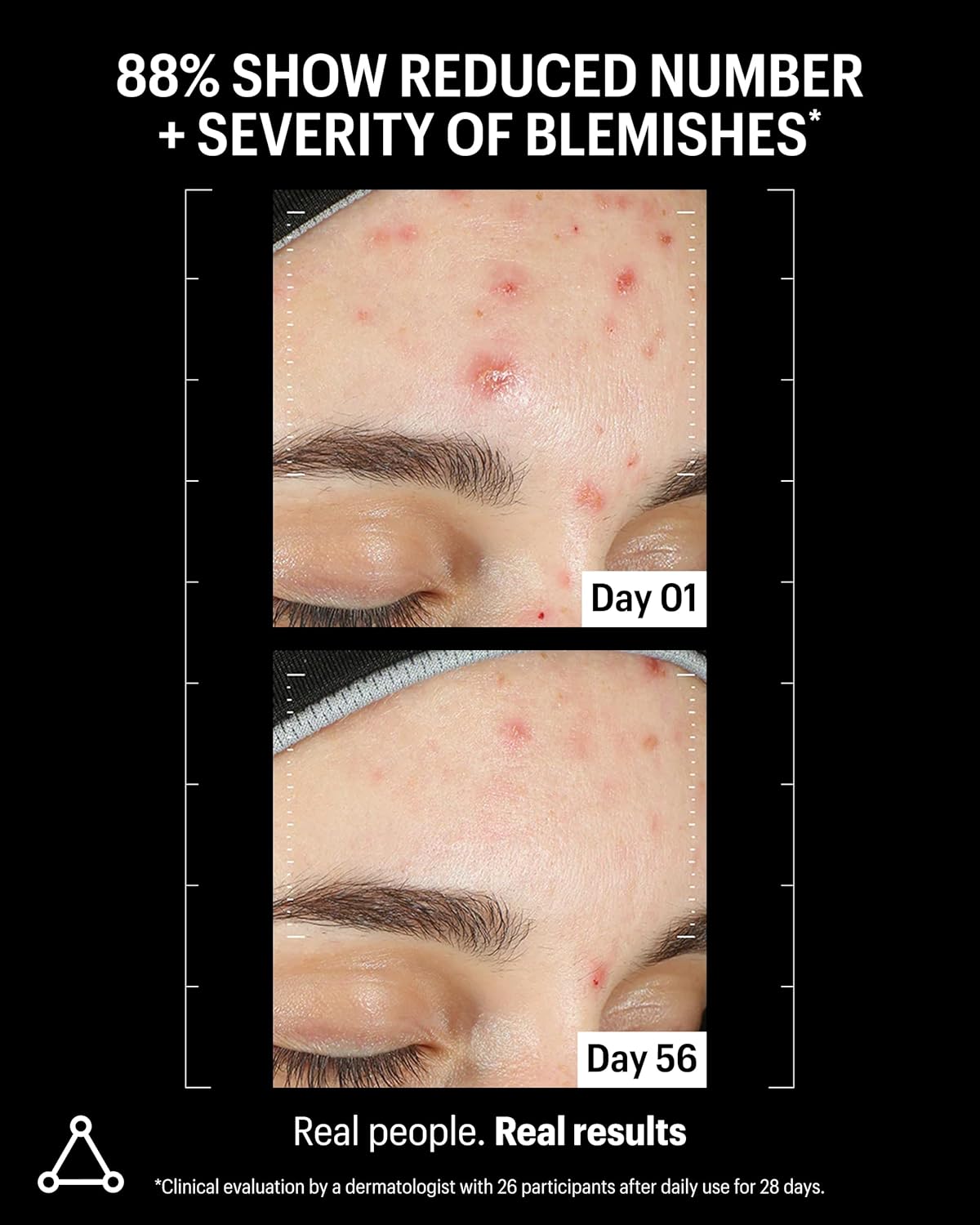 Allies of Skin Azelaic & Kojic Clarifying Face Serum | Clinically Proven for Acne & Blemish Prone Skin |10% Azelaic Acid Treats Pigmentation and Redness | Targets Pores & Uneven Skin Texture (1 Fl oz)