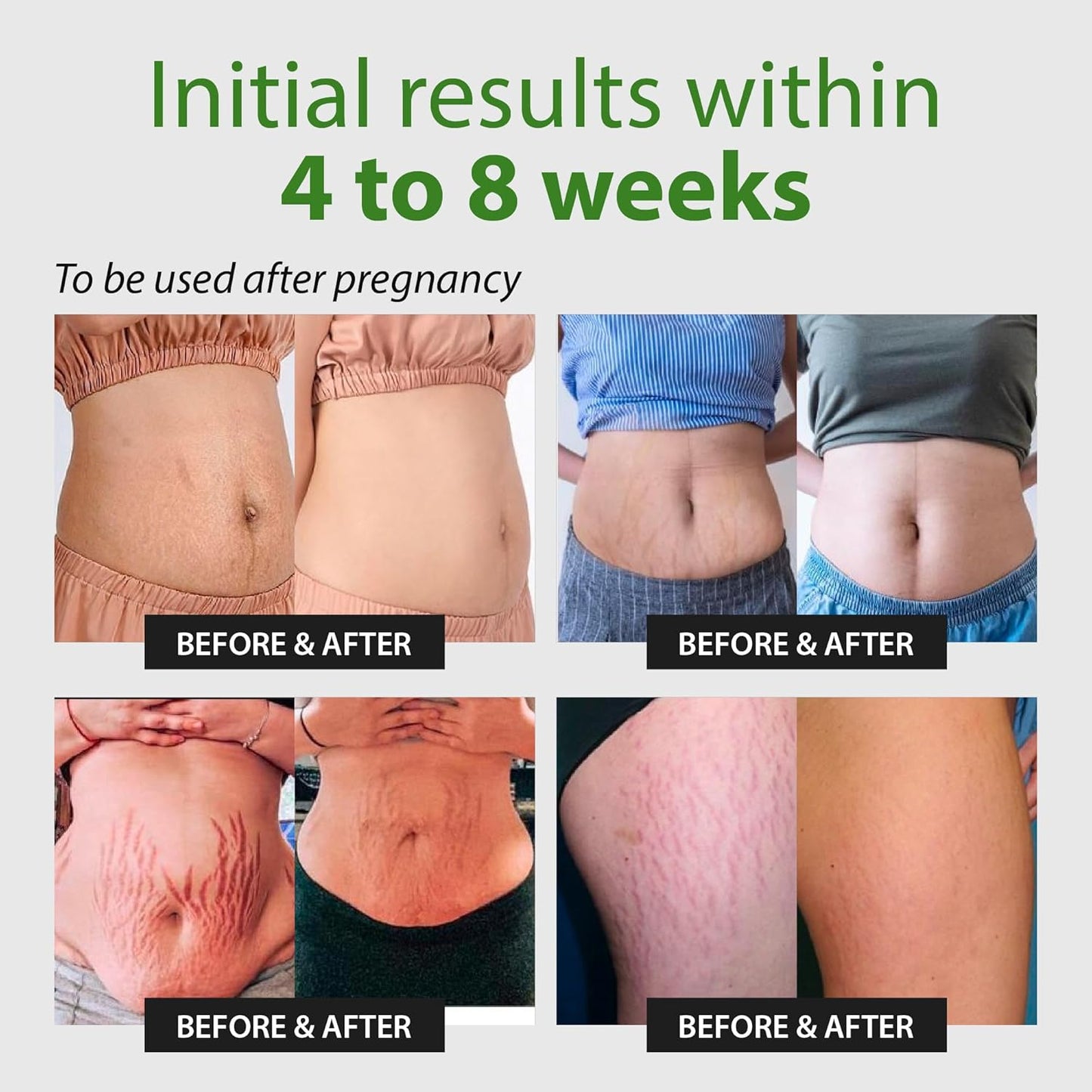 Abera Ovela Maternity Stretch Mark Cream for Pregnancy and Weight Fluctuations, Stretch Mark Treatment Pregnancy Must Haves, Deep Stretch Mark Removal, All Skin Types, 1.69 fl oz, Set of 2